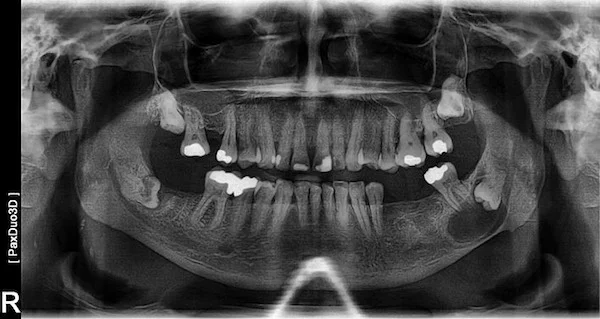 Cyst Removal Procedure