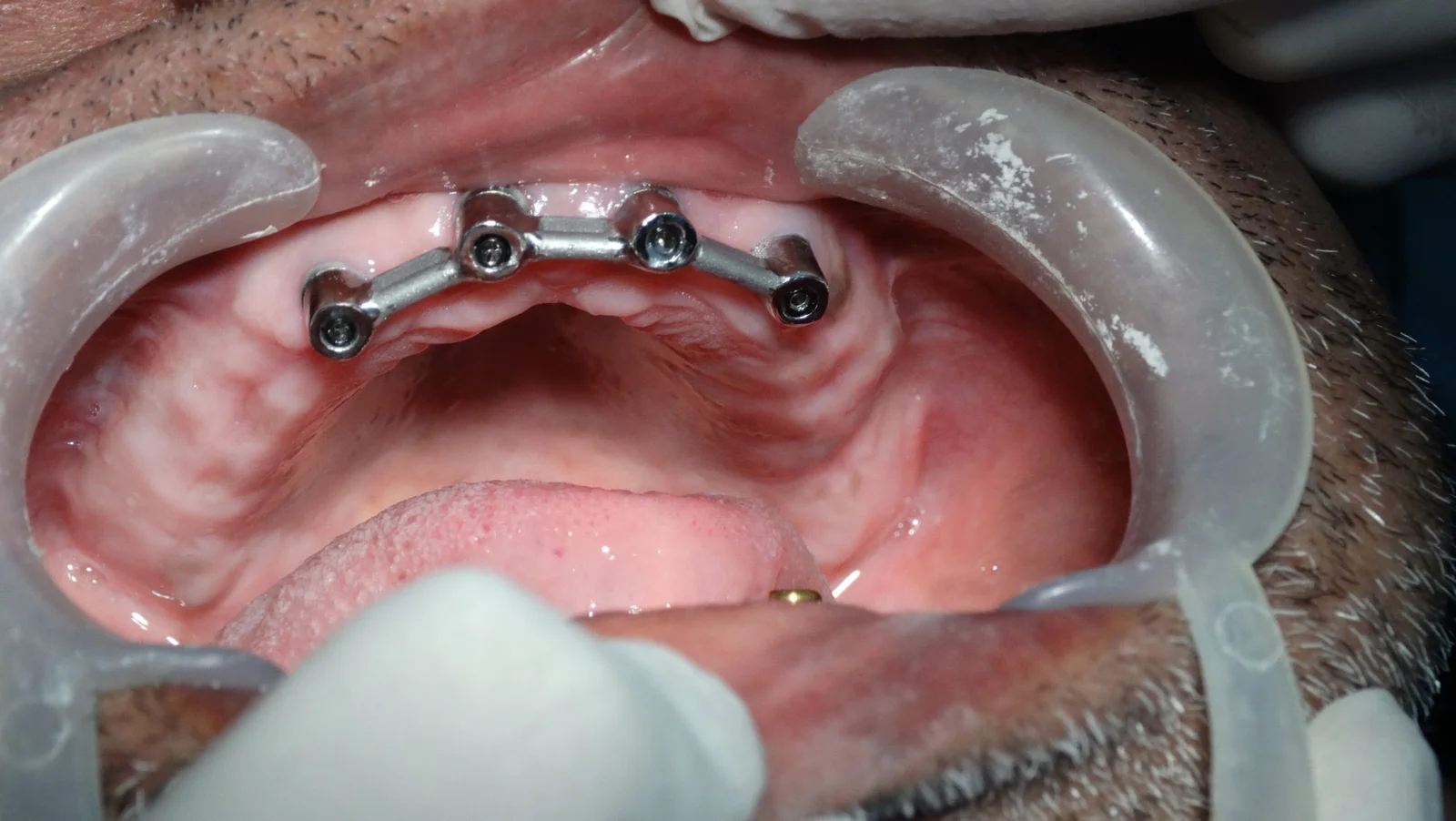 Removal Denture Stage 2