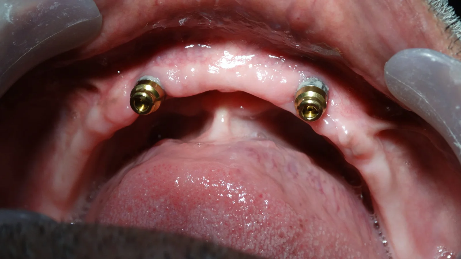 Removal Denture Stage 1