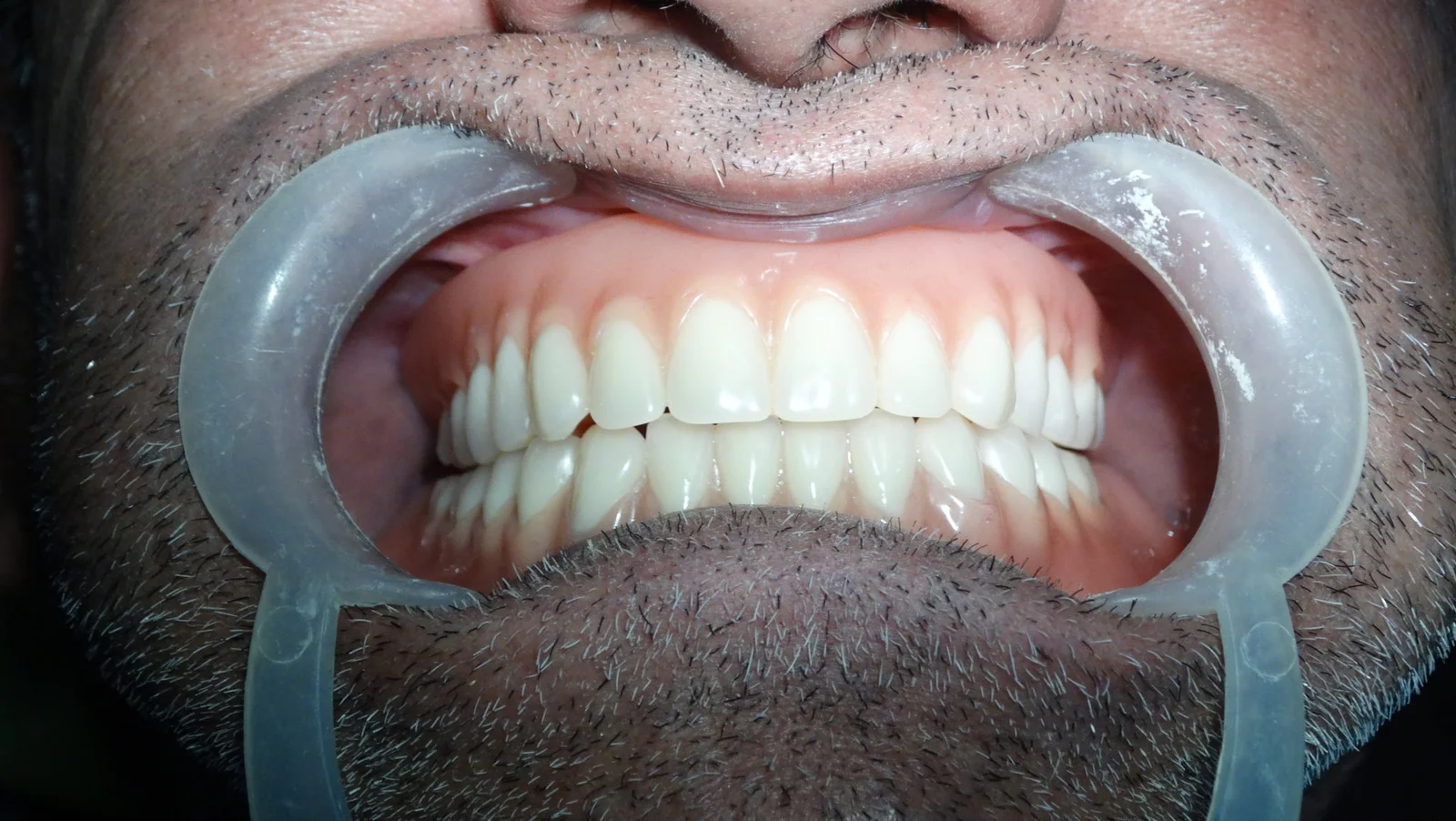 Removal Denture Stage 3