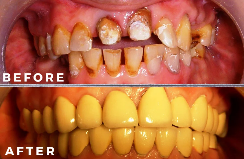 Full Mouth Rehabilitation