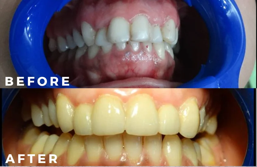 Smile Design Before and After
