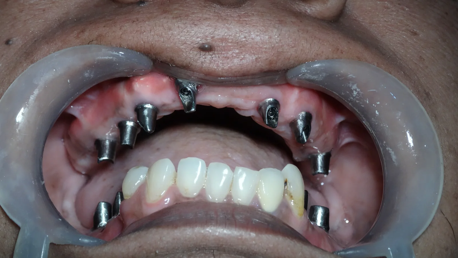 Fixed Teeth Case Study 5