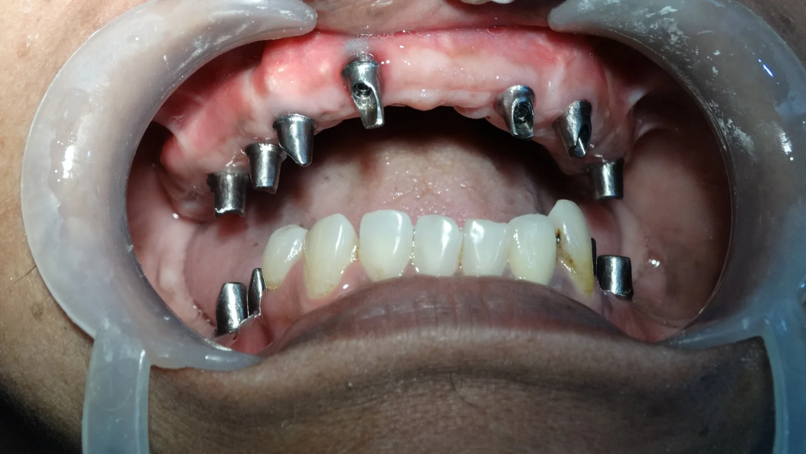 Fixed Teeth Case Study 4