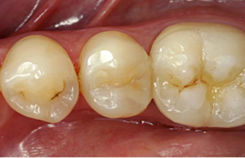 Early Cavity Detection