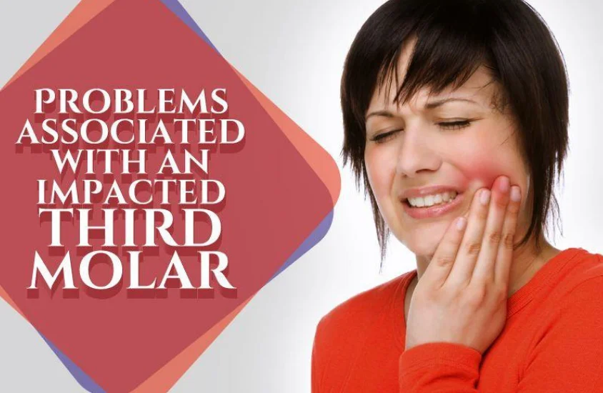 Wisdom Tooth Removal