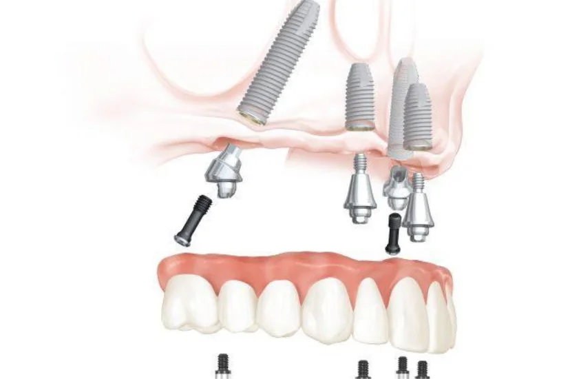 All on Four Clinical Result