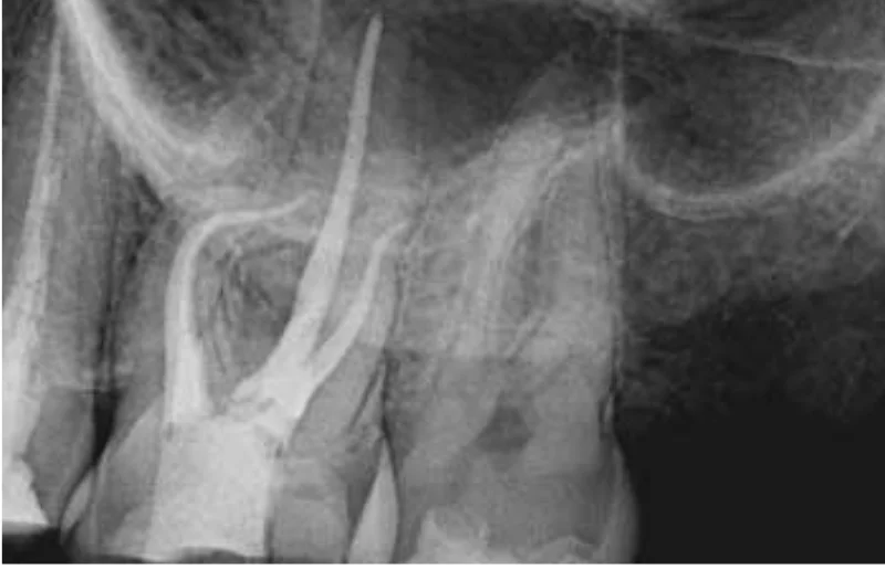 Root Canal Treatment