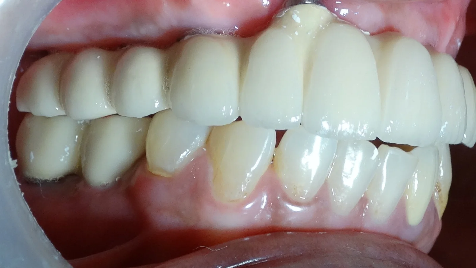 Fixed Teeth Case Study 6