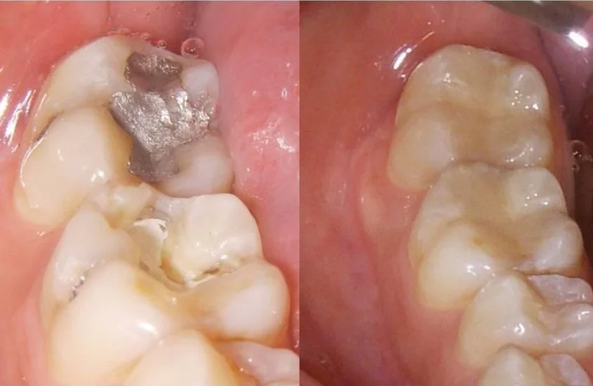 Tooth Color Fillings