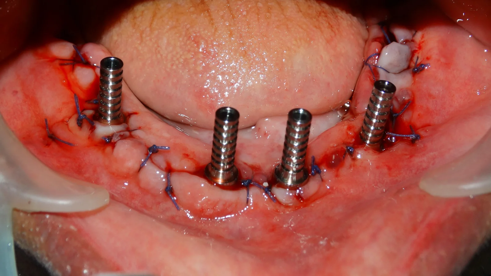 Zygomatic Case Study 3