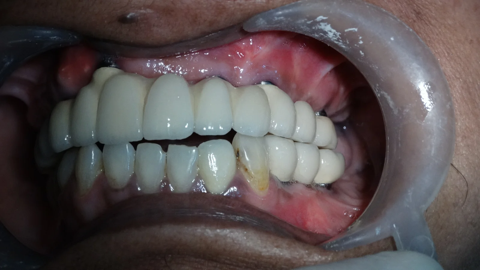 Fixed Teeth Case Study 1