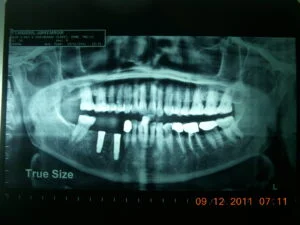 Implant Placement Stage